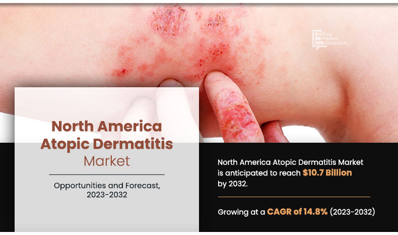 North America atopic dermatitis market Infographics