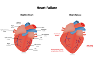 Congestive Heart Failure (CHF) Treatment Devices Have Set an Example in ...